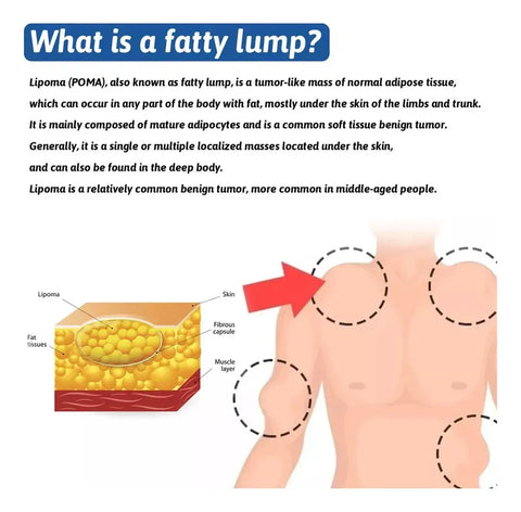 LIPOMA REMOVAL SPRAY (IMPORTED)